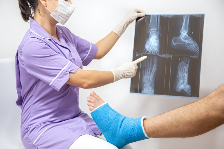 What is a bone fracture?